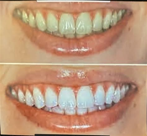 teeth whitening lodi|Teeth Whitening .